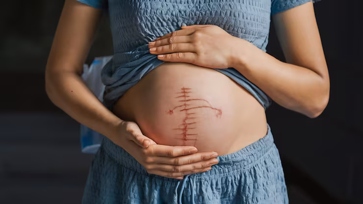 C-Section Delivery